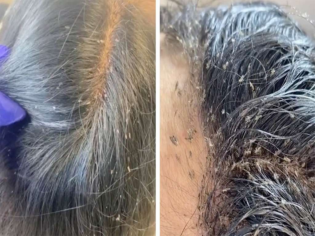 hair-lice